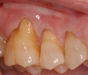 Photo of receding gums.