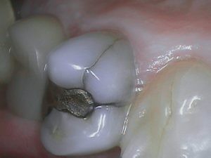Photo of a cracked metal, or Amalgam, filling.